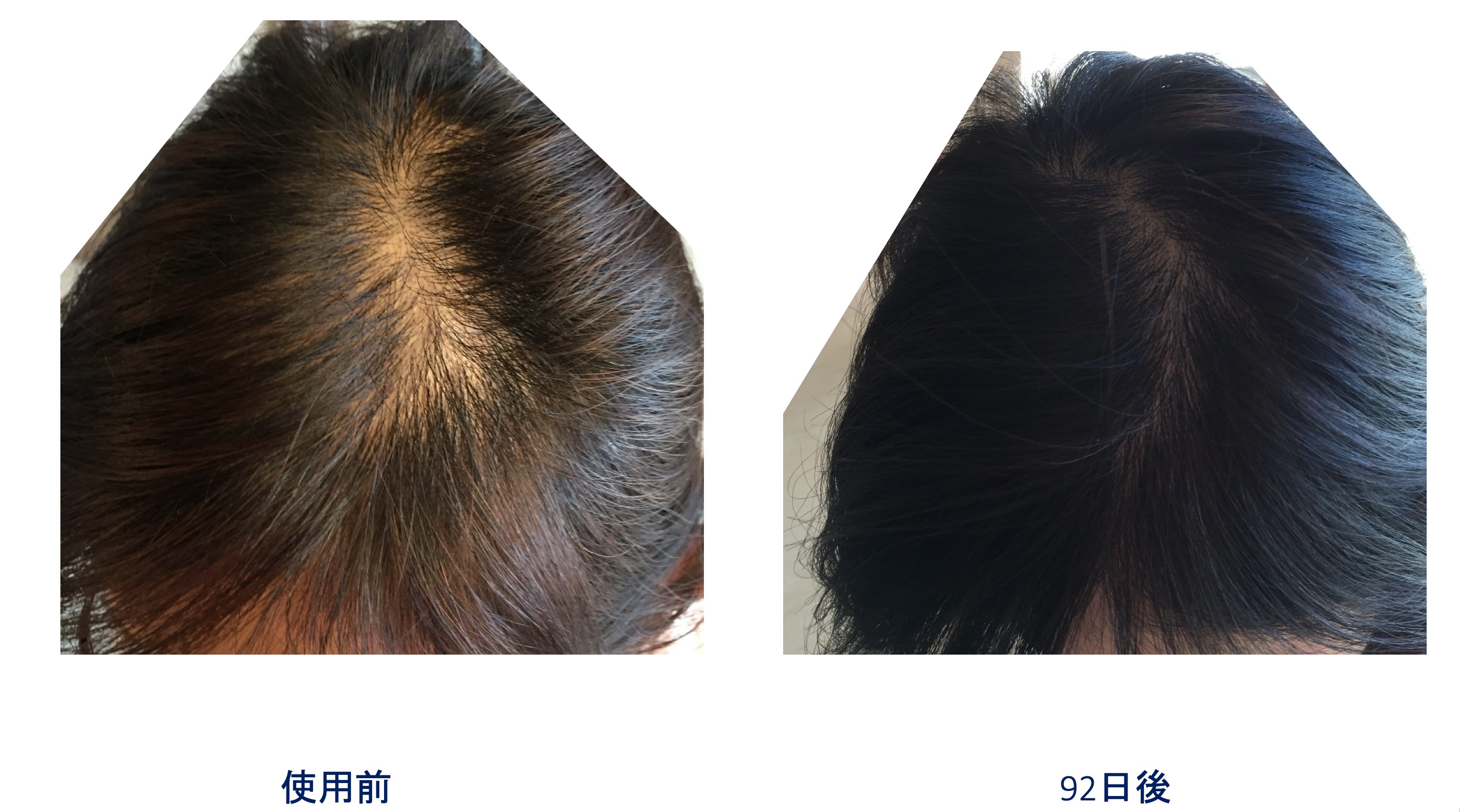 女性の薄毛ためのヘアサプリメント Ogshi おぐし 院長ブログ 咲くらクリニック