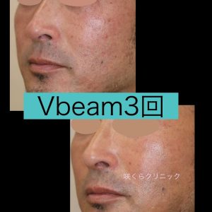 赤ら顔はVbeam（ブイビーム）で退散。