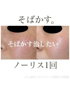 そばかすは普通1回の処置でよく取れます。 使ったのはIPLのノーリス。そばかすの治療に何度もお金を払う必要はありません。