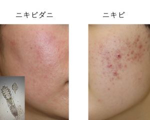 ニキビ薬をもらってるのに治らない、赤ら顔がずっと続く、ニキビみたいだけどなんだかむず痒い、 このような時はニキビダニかも。