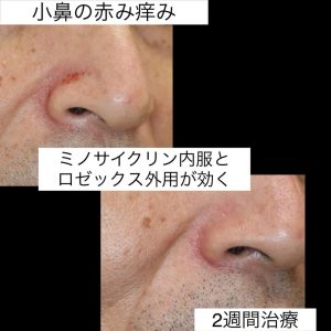 小鼻の血管を消すにはIPLのノーリスがとても良く効きますが、小鼻の赤みと痒みならミノサイクリン内服とロゼックス外用がとても効きます。