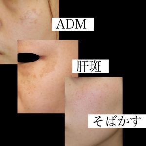 ADMと肝斑とそばかすの区別ができない美容皮膚科の多いこと。患者さん達も賢くならないと無駄な出費が増えるだけです。